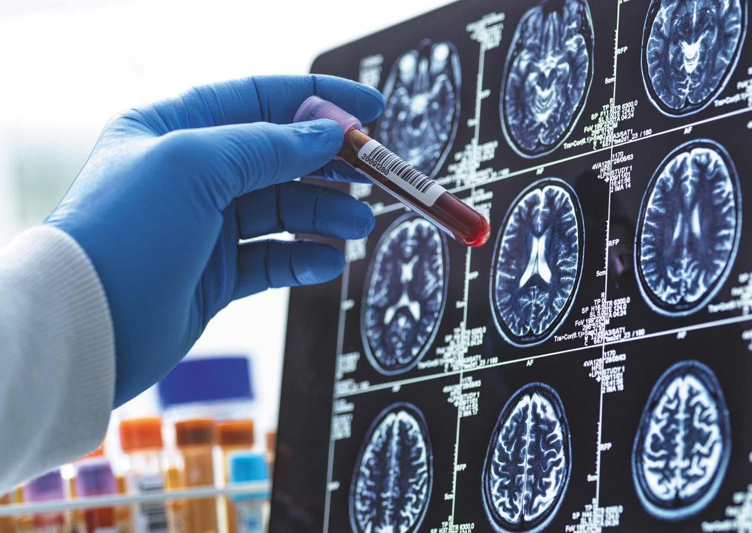 Early Alzheimer’s Detection with Biomarkers