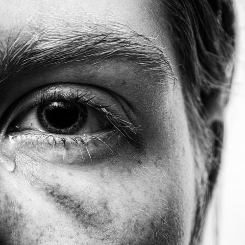 Eye Trauma from Toy Guns: Protect Eyes from Paintball & Air Guns