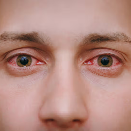 Pink Eye: Causes, Symptoms, Treatments & Prevention