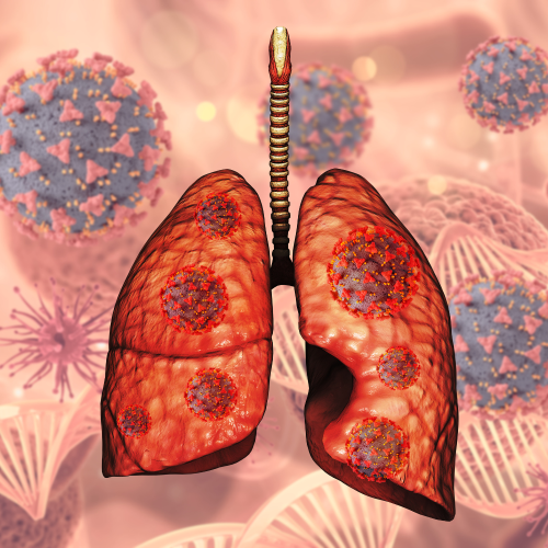 Pulmonary Embolism Death Rates: Trends, Risks, and Prevention