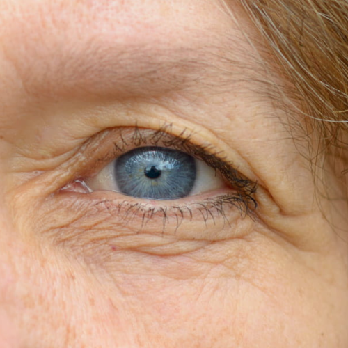 Eye Microvascular Disease After Preeclampsia: Heart Risk