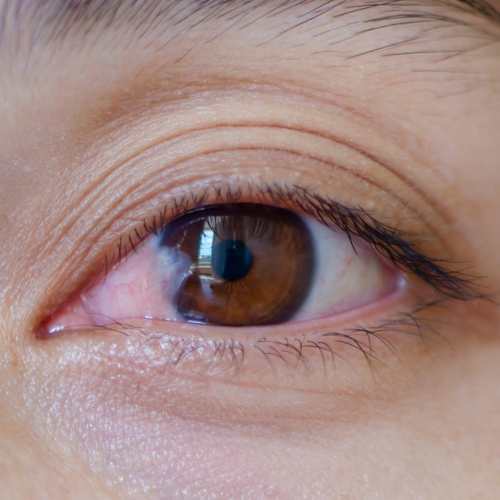 Pinguecula and Pterygium: Eye Growths Explained