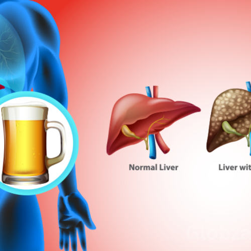 Alcoholic Liver Disease: Early Action Saves Lives