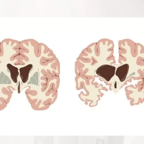 Gene Therapy for Huntington’s Disease: Promising Breakthrough