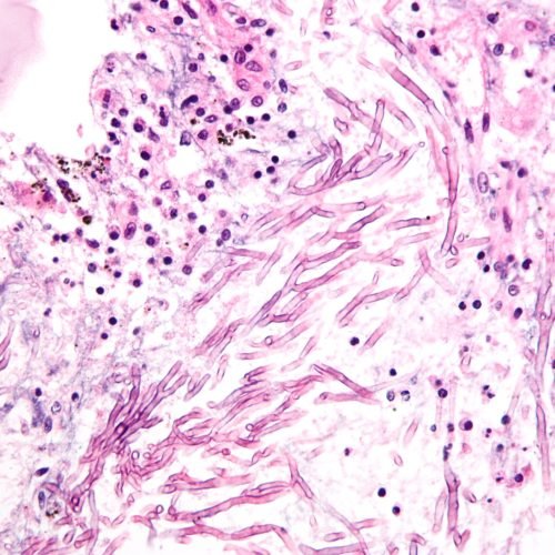 Deadly Fungal Infections Rising: Global Health Threats