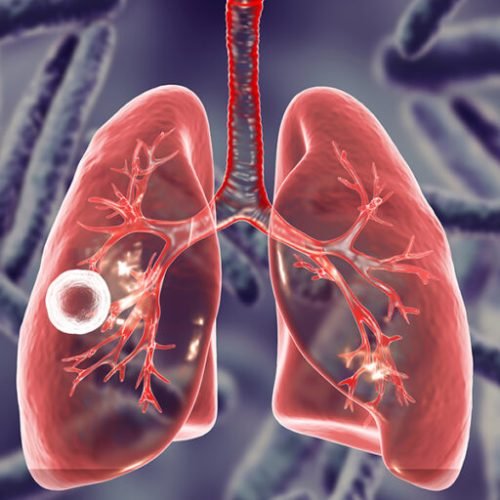 Fibrous-cavernous pulmonary tuberculosis, 3D illustration showing tuberculosis cavity in the lung