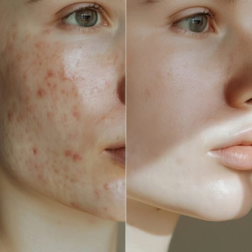 Back-to-School Acne Treatment: Dermatologist Tips for Clear Skin