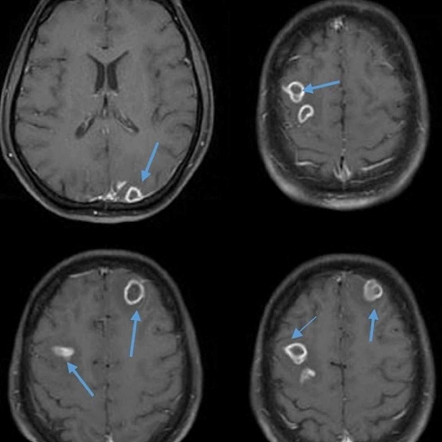 Brain Abscess Symptoms in Children: Causes and Trends