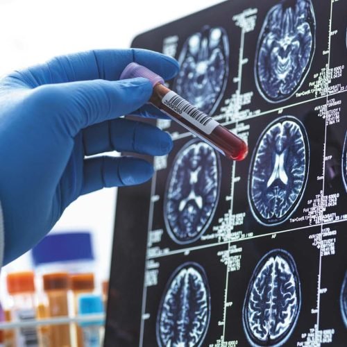 Early Alzheimer’s Detection with Biomarkers